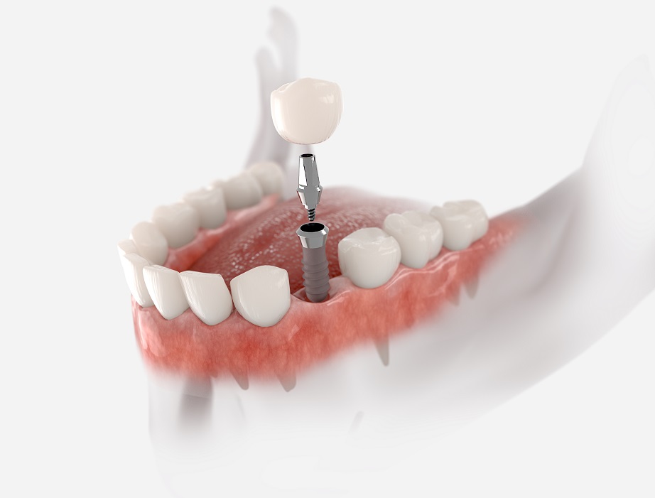 Featured image for “Fill Dental Gaps With Dental Implants”