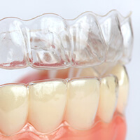 Invisalign in Greeley, CO