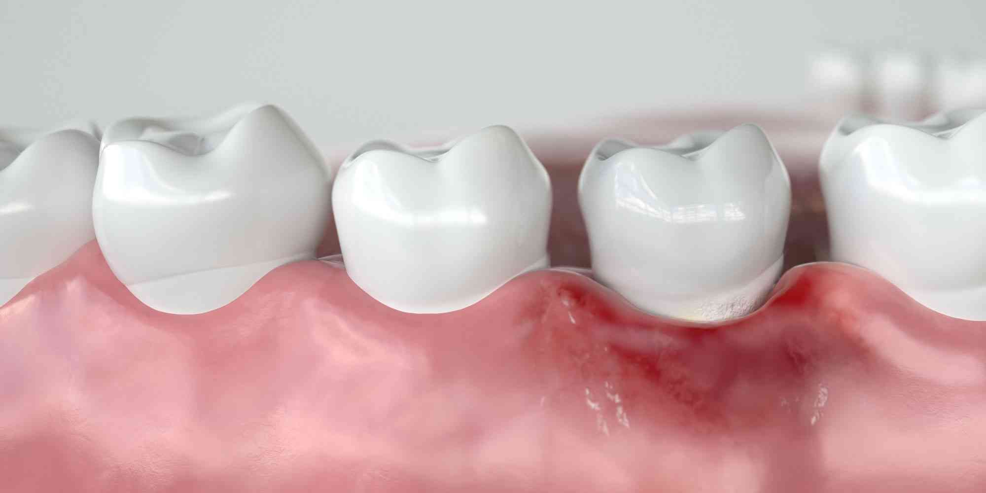 Featured image for “Receding Gums Treatment: Surgical Options”